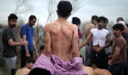 آثار تعذيب على جسد طالب لجوء في اليونان/ وكالات