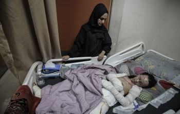 طفلة مصابة بحروق خطيرة جراء قصف 