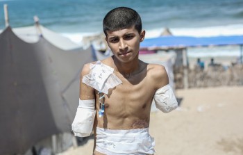 الطفل الفلسطيني ضياء العديني بترت ذراعاه الاثنتان جراء قصف 