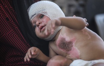 طفل فلسطيني جريح في قطاع غزة