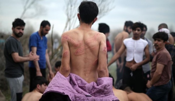 آثار تعذيب على جسد طالب لجوء في اليونان/ وكالات