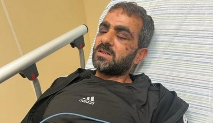 الأسير زهران بعد الإفراج عنه وبدت عليه آثار الاعتداءات