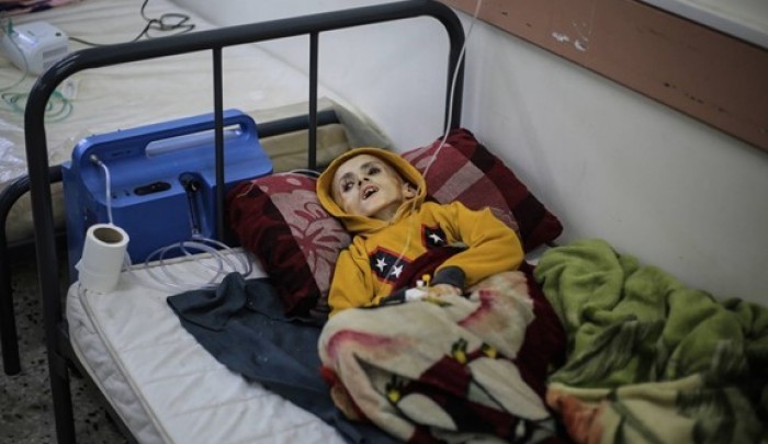 الطفل يزن كفارنة الذي ارتقى بسبب حصار الاحتلال في مدينة رفح (د.ب.أ)