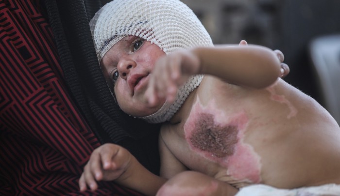 طفل فلسطيني جريح في قطاع غزة